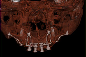 Fig.25 - Scanner 3D  les plaques  sont en contact intime avec les parois osseuses