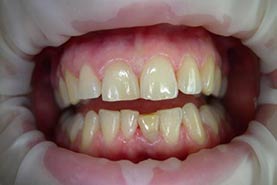 Fig.31 - Avant l'éclaircissement dentaire
