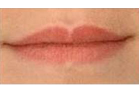 Fig.33 - Volume des lèvres avant traitement