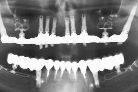 Fig.45 - Atrophie mandibulaire postérieure. 2 plaques à vis d'ostéosynthèse sont placées et reliées aux dents pour un bridge complet