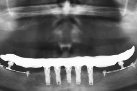 Fig.46 - 5 implants axiaux dans la région mentonnière et 2 plaques trigones